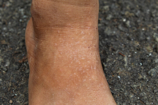 skin condition in the ankle area that experiences white spots or hypopigmentation (such as Idiopathic Guttate Hypomelanosis or mild vitiligo)
