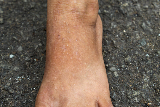 skin condition in the ankle area that experiences white spots or hypopigmentation (such as Idiopathic Guttate Hypomelanosis or mild vitiligo)