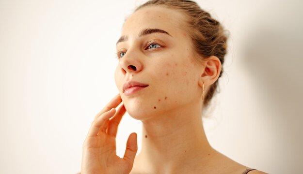 A close-up of a young woman with problematic skin touching her face in a brightly lit room. The woman examines her blemishes in a small mirror on a sunny day. Health and skincare concepts.