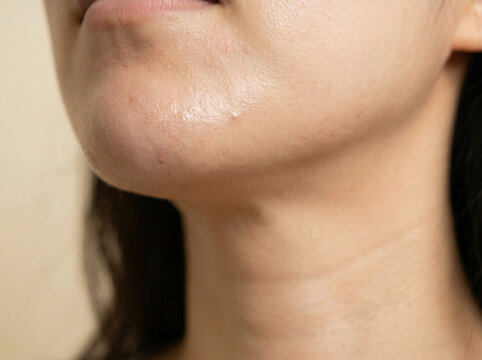 피부 비포 애프터 AI 피부개선 Skin Before After AI Skin Improvement