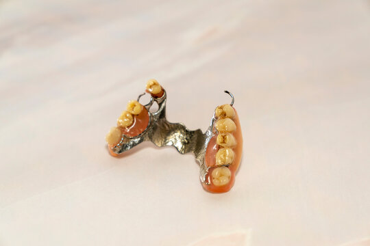 Partial removable dental denture with metal frame and artificial teeth isolated on white background. Macro studio shot. Dental prosthetics and oral healthcare concept.