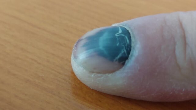Severe subungual hematoma under fingernail on finger close up