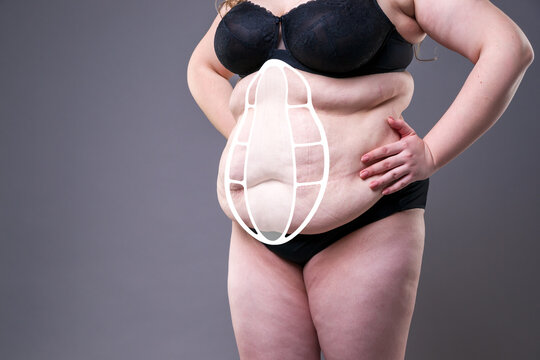 Diastasis recti and obesity medical concept. Overweight female belly with separated rectus abdominis muscles