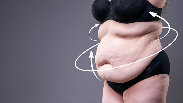 Tummy tuck and weight loss concept. Overweight woman in pinching belly fat with body contouring arrows