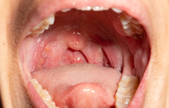Open mouth showing sore throat with swollen uvula tonsils and posterior pharyngeal wall, influenza follicles in upper respiratory tract. Infection, diagnosis and clinical examination in healthcare.