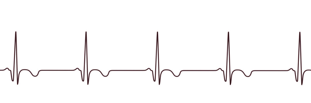 Subacute stage of myocardial infarction, 3D