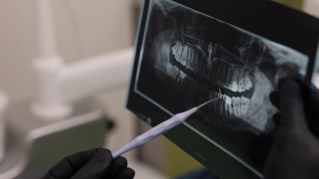 Close-up X-ray, Dental hygiene, Tooth radiograph. In close-up, gloved hand examines dental X-ray with dental tool.