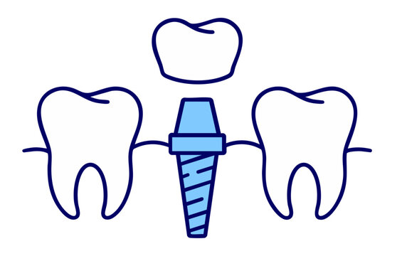 Dental Implant Procedure with Artificial Tooth Root and Crown Replacement, Missing Tooth Restoration