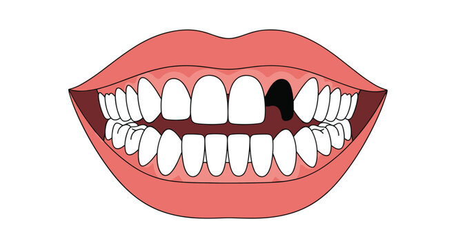 Human mouth with pink lips and white teeth showing a noticeable gap where a single tooth is missing in the upper jaw.