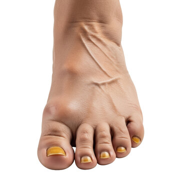 an extreme macro view of an aged human foot showing hallux valgus, hammertoe, and onychomycosis against a sterile white background, medical diagnostic concept