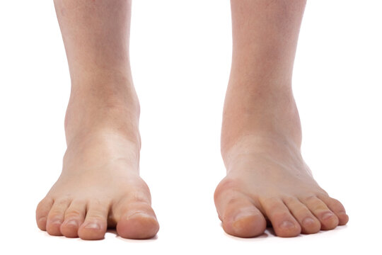 Close-up of bare adult feet showing flat-footed arch and ankle on a white background, useful for foot health, podiatry, or orthopedic contexts.