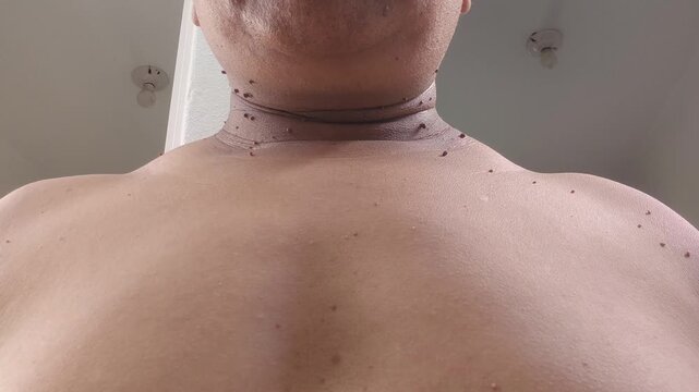 Dermatological view of skin lesions on human neck