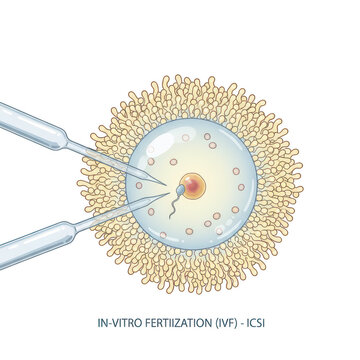 Icsi procedure injecting sperm into human egg cell isolated on a transparent background