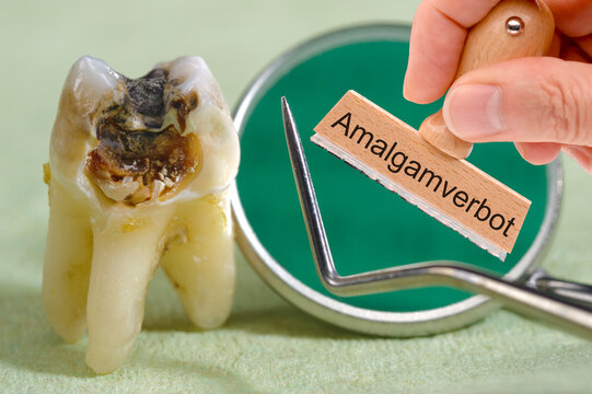 Ein Holzstempel in der Hand ist beschriftet mit Amalgamverbot vor einem mit Karies befallenen Backenzahn - FOTOMONTAGE