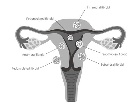 Female uterus with common types of uterine fibroids. Educational medical diagram for use in gynecology and the reproductive system. Vector illustration isolated on white background.