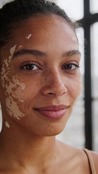 A confident young woman with vitiligo and freckles looks at the camera. This authentic close up portrait features soft natural light, showcasing skin positivity and diversity. Neutral colors