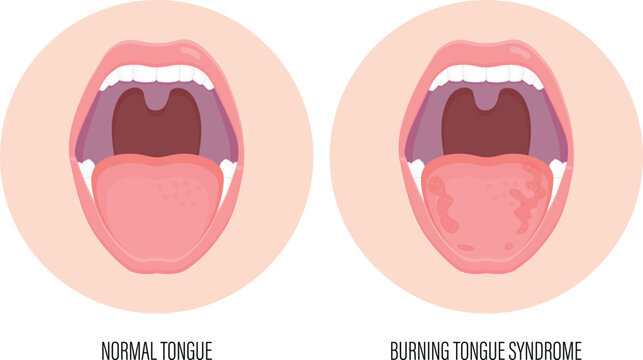 Comparison medical diagram between normal tongue and burning mouth syndrome showing inflammation and redness symptoms