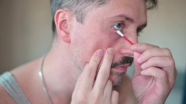 He carefully cleans the affected area using a cotton swab and observes the inflammation closely. A man studies his eye while addressing a chalazion, a chronic condition causing swelling