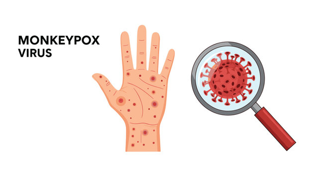 Medical illustration of monkeypox virus with human hand showing skin lesions and magnified view of the virus structure.