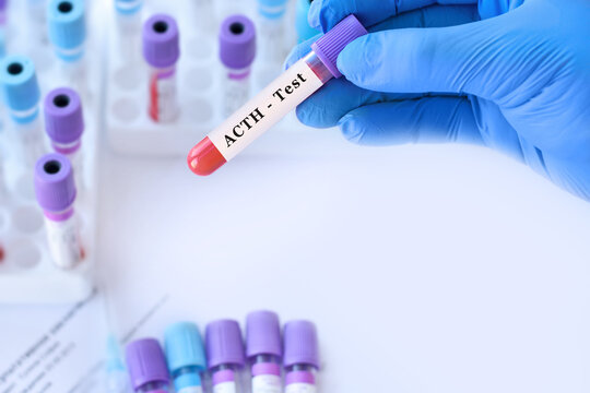ACTH progesterone blood test for adrenal and pituitary hormone function assessment with doctor holding laboratory sample tube during endocrine diagnostics and clinical analysis copy space