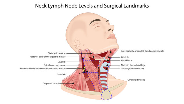 Neck Lymph Node Levels and Surgical Landmarks
cervical lymph node levels (I&ndash;V) with key anatomical landmarks and surrounding muscles of the neck.