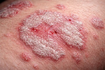 Fototapeta premium Close up clinical photography of psoriasis vulgaris skin condition for medical journals