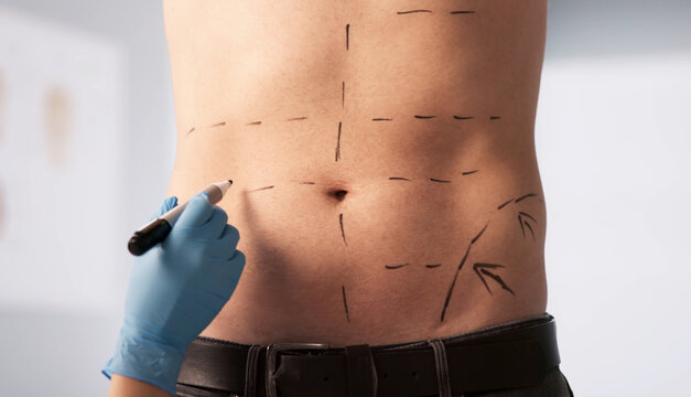Plastic Surgeon Gently Marks Male Patient&rsquo;s Abdomen In Preparation
