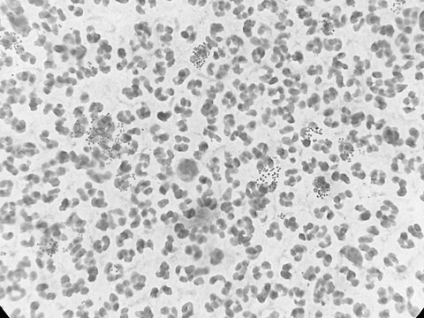 Microscopic image of urethral smear for Gram stain. Gram negative intra and extracellular diplococci are seen. 