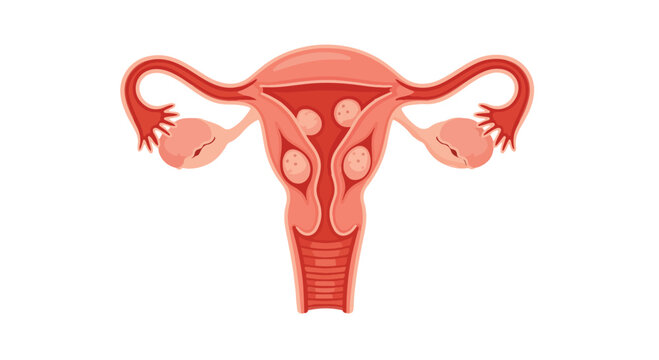 Illustration of the female reproductive system showing uterus, fallopian tubes, and ovaries with fibroids