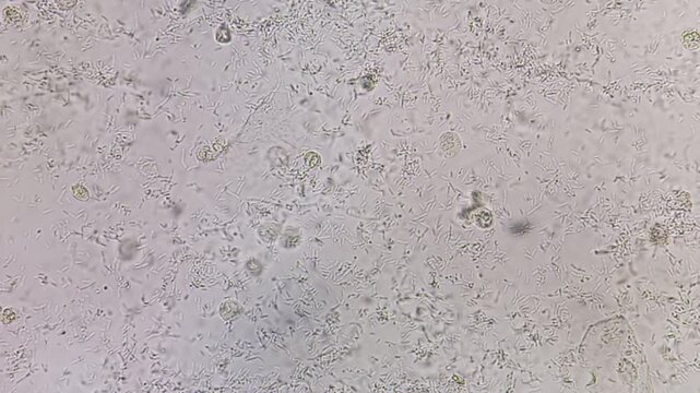 Microscopic urinalysis seen plenty pus cells with Escherichia coli bacteria.