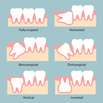 Medical illustration of wisdom tooth eruption stages and various impaction angles in human jaw