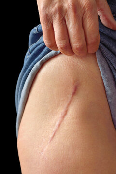 Minimally invasive Total hip replacement, 4.5 years later.