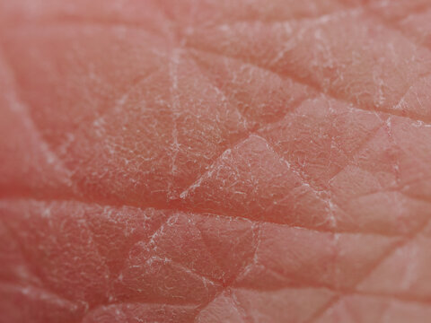 Extreme Makroaufnahme von trockener menschlicher Haut, dermatologische Details