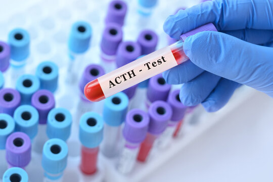 ACTH progesterone blood test for adrenal and pituitary hormone function assessment with doctor holding laboratory sample tube during endocrine diagnostics and clinical analysis copy space