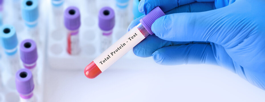 Doctor holding total protein blood test tube explaining evaluation of protein balance, nutritional status, liver and kidney function during routine laboratory diagnostics