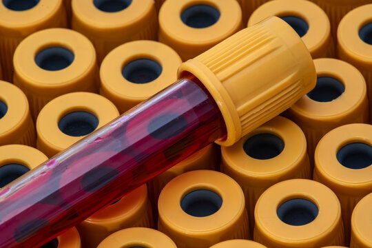 Close-up of a medical vacuum test tube filled with a red blood sample for clinical analysis, resting on a background of multiple yellow-capped tubes in a laboratory setting for diagnostics