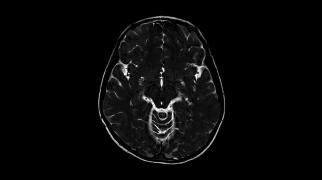 Medical MRI brain scan video showing detailed intracranial structures with high clarity and precision. Radiology footage perfect for illustrating neurological examination and healthcare technology.