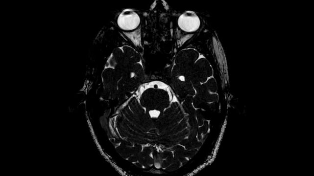 MRI brain scan footage showing detailed cross-sectional anatomy of the human brain in motion. High-resolution medical imaging video ideal for neurology, diagnostics, and healthcare concepts.