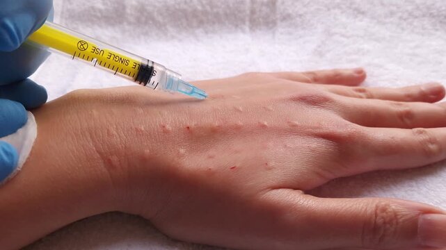High angle shot of a cosmetologist performing multiple micro-injections on the back of a woman's hand. Visible skin reaction and professional technique.