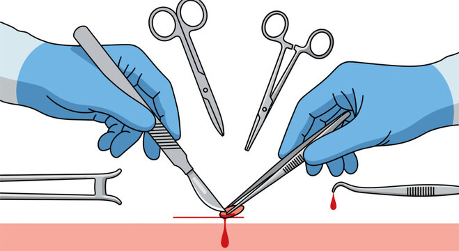Close-up vector illustration of a surgical procedure with gloved hands holding a scalpel and forceps. Concept of surgery, incision, and medical treatment.