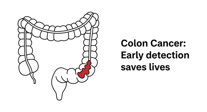 Colon cancer awareness illustration with large intestine anatomy and early detection message.