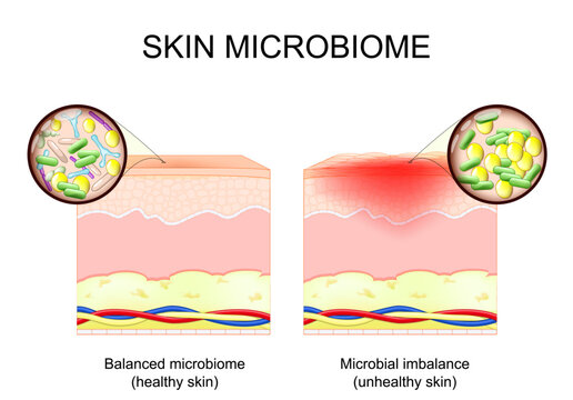 Skin microbiome. Close-up of Microbial imbalance and Balanced microbiome