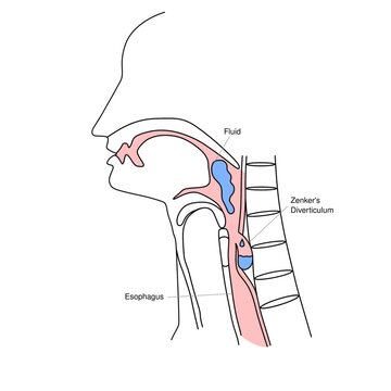 Zenker&rsquo;s Diverticulum Medical Illustration