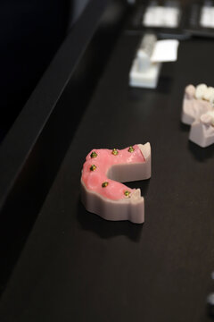 implantes de dientes