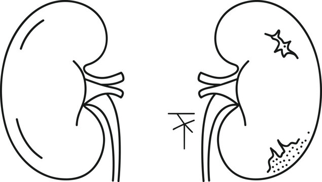 Kidney disease vector illustration showing damaged renal organs with cracks stones and pathology in minimal line art medical diagram design