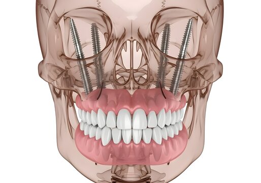 Transparent skull with dental implants and dentures showing the skeletal structure clearly visible
