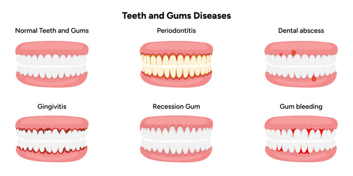 Hand-drawn illustration set showing common dental and gum problems, including periodontitis, gingivitis, gum recession, dental abscess, and gum bleeding. Educational infographic 