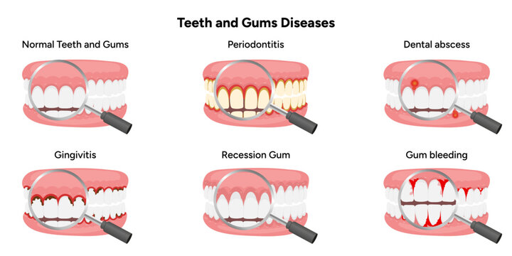 Hand-drawn illustration set showing common dental and gum problems, including periodontitis, gingivitis, gum recession, dental abscess, and gum bleeding. Educational infographic 