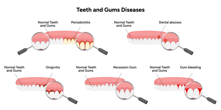 Hand-drawn illustration set showing common dental and gum problems, including periodontitis, gingivitis, gum recession, dental abscess, and gum bleeding. Educational infographic 