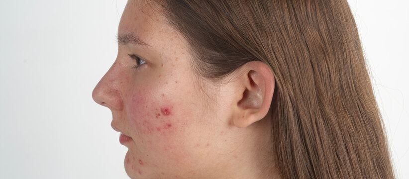 Pimple on skin. Pimples on young girl face in closeup. Pimple medical problem for treatment. Acne skin. Acne blemish rash on face. Acne pore texture. Teenagers acne.